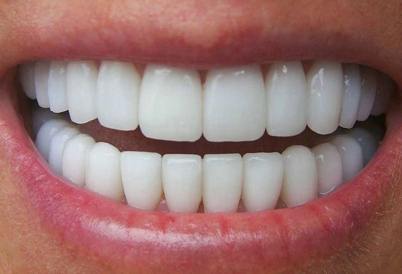 Bọc răng sứ Veneer không gây ảnh hưởng đến răng thật