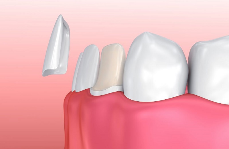Phương pháp bọc răng sứ không mài có nhiều ưu điểm vượt trội nên giá tương đối cao