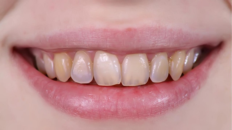 Bọc răng sứ thích hợp với những người bị răng xỉn màu