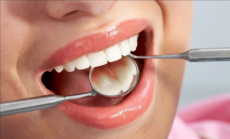 Phương pháp trám răng thẩm mỹ là phương pháp làm răng thỏ phổ biến nhất