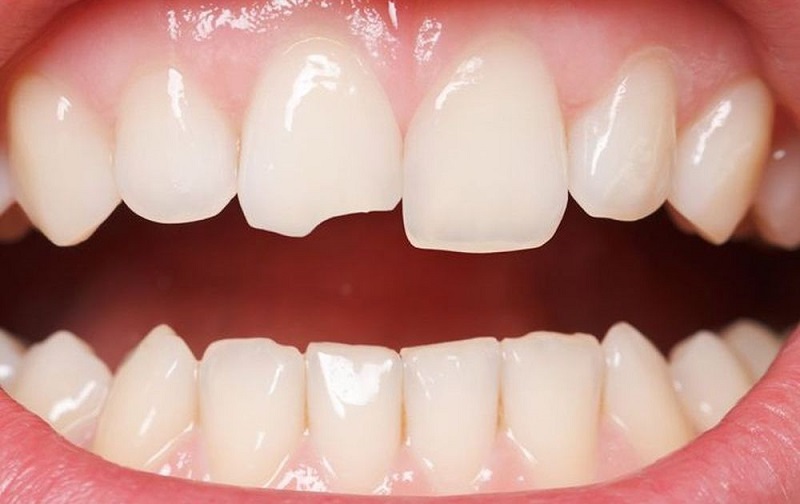Trường hợp răng sứ bị sứt, mẻ hoặc gây ra hiện tượng đau nhức răng thì cần đi bọc lại