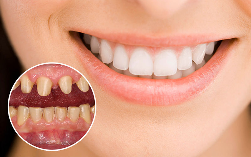 Thời gian bọc răng sứ nhanh hay chậm còn phụ thuộc vào tình trạng răng miệng của người bệnh