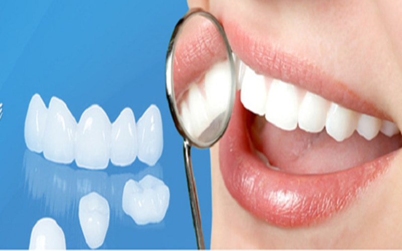 Số lượng răng cần bọc sứ ảnh hưởng trực tiếp đến thời gian hoàn thành