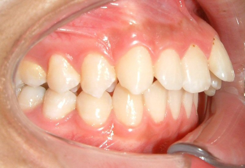 Răng cửa bị hô bọc sứ có hiệu quả không?