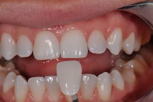 Giá thành bọc răng sứ phụ thuộc vào nhiều yếu tố