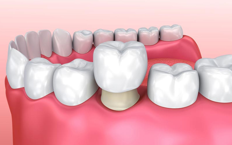 Bọc sứ răng cấm là phương pháp phục hình được áp dụng phổ biến hiện nay