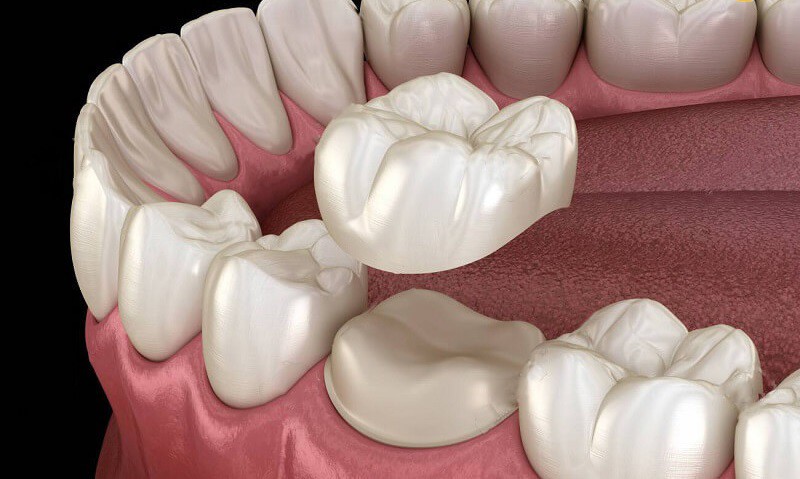 Sau khi răng sứ đã được làm xong, bác sĩ sẽ gắn lên hàm răng cho người bệnh