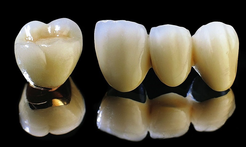 Răng sứ titan được sử dụng phổ biến để bọc răng hàm