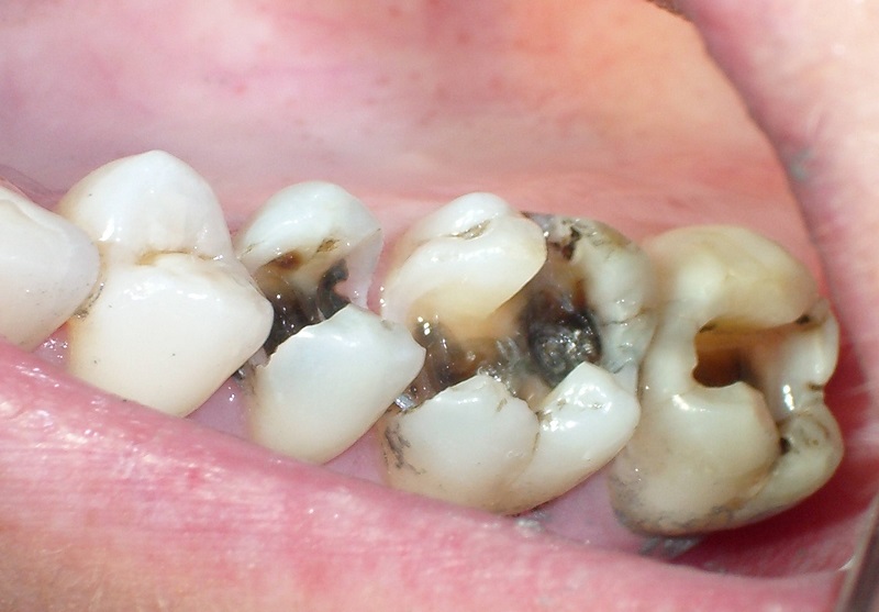 Răng hàm đóng vai trò ăn, nhai nên rất dễ bị các vấn đề về răng miệng