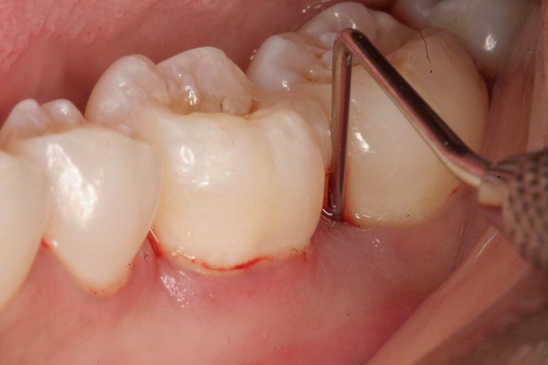 Răng bị mòn, có nhiều vết cắt cần được bọc răng sứ