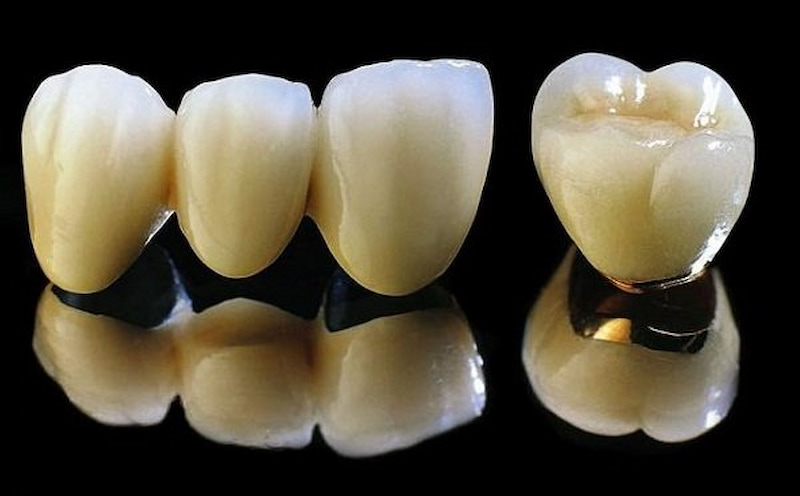 Răng sứ kim loại được sử dụng phổ biến hiện nay