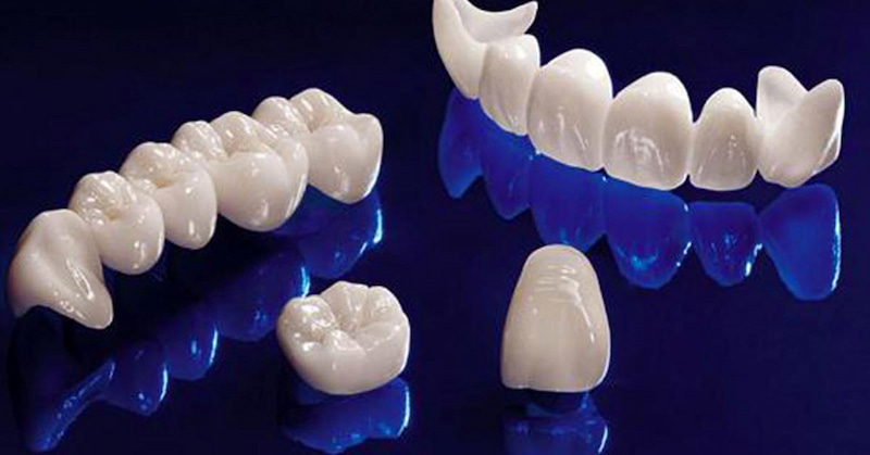 Răng toàn sứ có nhiều ưu điểm nổi trội so với những loại khác