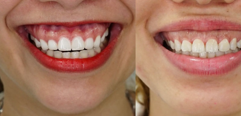 Cắt lợi bọc răng sứ là phương pháp được thực hiện với thủ thuật đơn giản