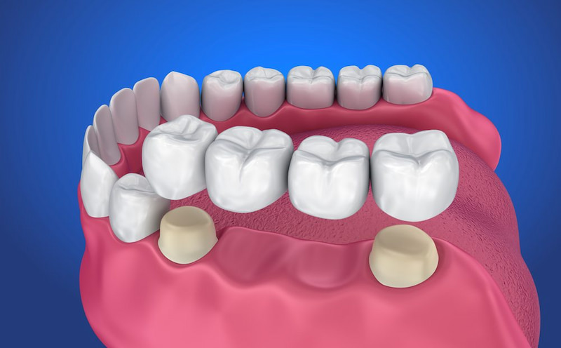 Cầu sứ trong trồng răng được áp dụng rộng rãi tại các phòng khám nha khoa