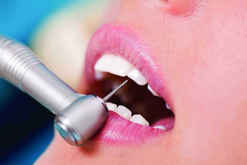 Mài răng khi đặt mào sứ được tính toán cẩn thận để tránh gây hại đến răng thật