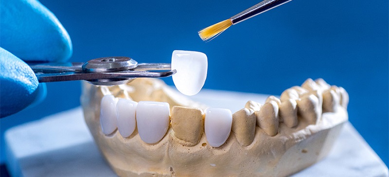 Chi phí chụp răng còn phụ thuộc vào loại răng mà bạn sử dụng