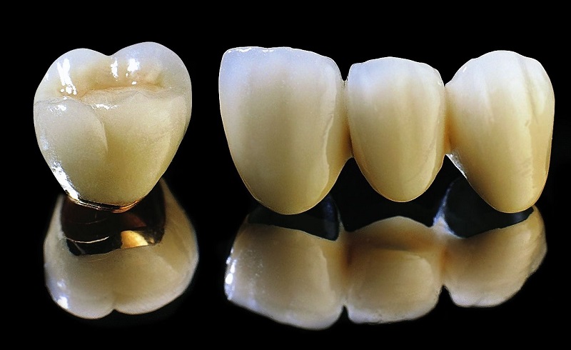 Răng sứ chất liệu titan có độ bền cực tốt