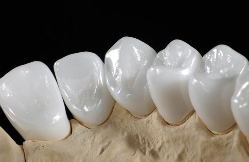 Răng toàn sứ có màu sắc tự nhiên rất giống với răng thật