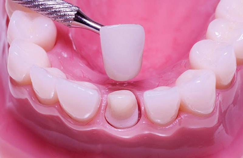 Răng sứ bạn nên chọn màu sắc gần với màu răng thật nhất