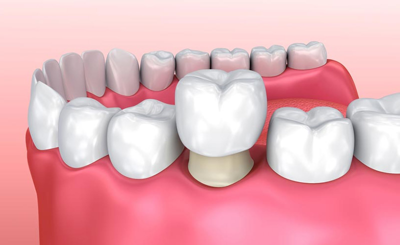 Chụp răng sứ là phương pháp nha khoa thẩm mỹ được ưa chuộng hiện nay