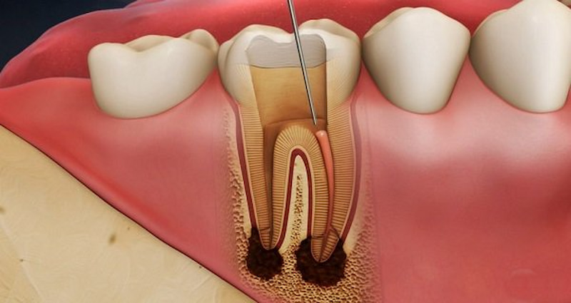 Mài răng tiềm ẩn nguy cơ viêm tủy nếu bác sĩ thực hiện không có đủ trình độ