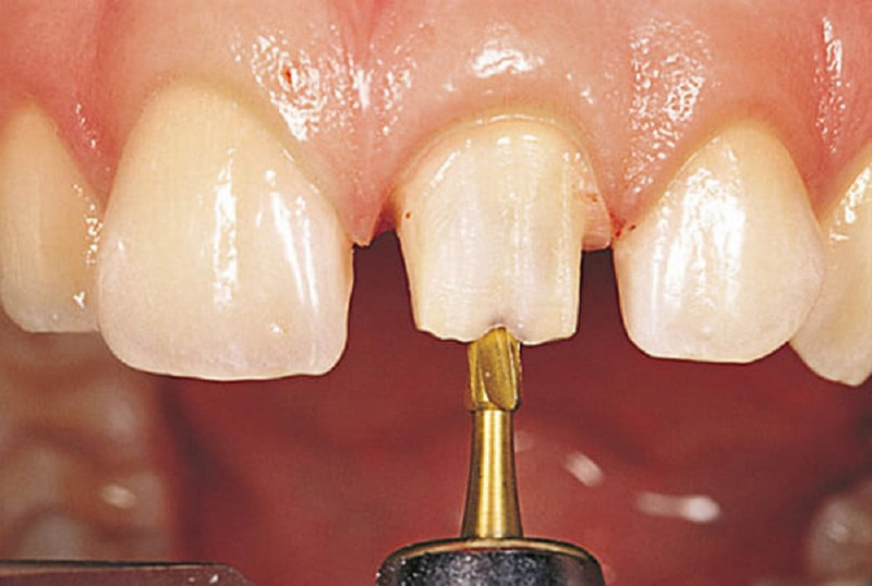Công nghệ bọc sứ truyền thống yêu cầu phải mài nhỏ răng thật