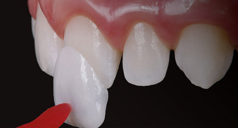 Công nghệ bọc răng sứ mới không nhất thiết phải mài đi răng thật