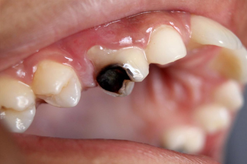 Trẻ bị sâu răng nặng có thể gây hỏng tuỷ răng