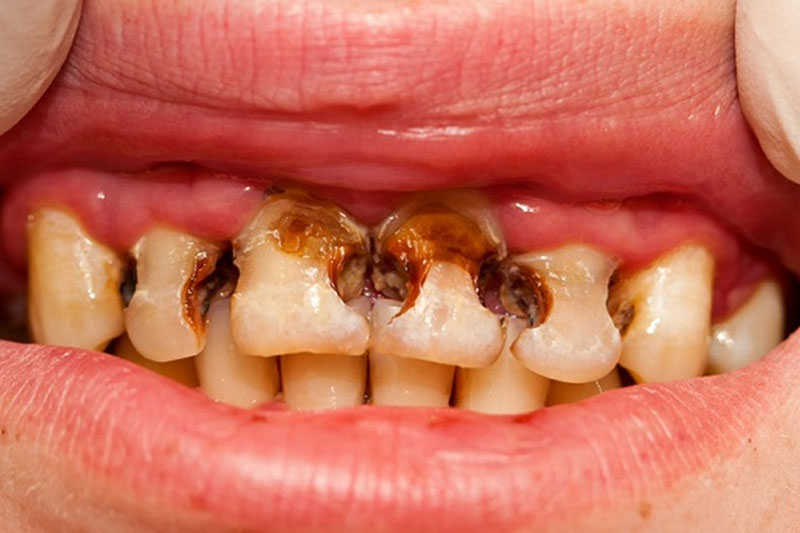 Bác sĩ sẽ có phương pháp chữa trị răng tuỳ theo mức độ sâu