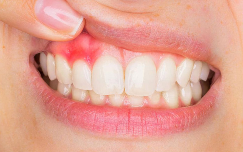 Bọc răng sứ không đảm bảo kỹ thuật có thể gây ra nhiều hậu quả nghiêm trọng