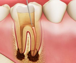 Lấy tuỷ răng là phương pháp điều trị giúp loại bỏ tuỷ răng đã bị viêm nhiễm