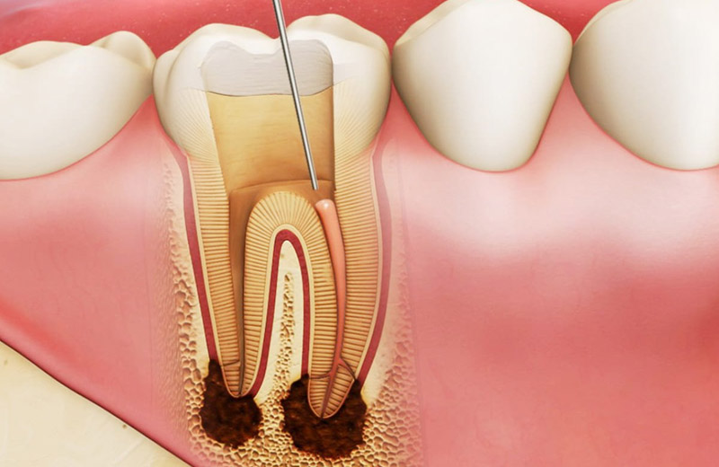 Lấy tuỷ răng là phương pháp điều trị giúp loại bỏ tuỷ răng đã bị viêm nhiễm