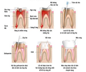 Quy trình thực hiện lấy tuỷ răng chuẩn nha khoa