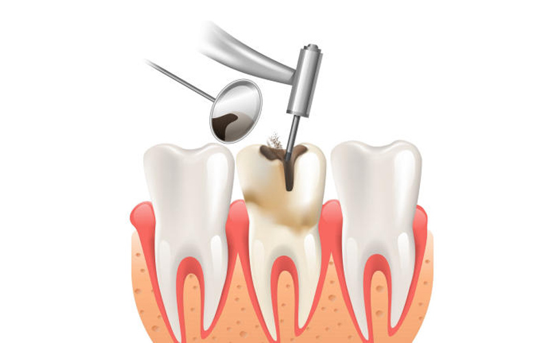 Lấy tuỷ bọc răng sứ giá bao nhiêu phụ thuộc vào nhiều yếu tố