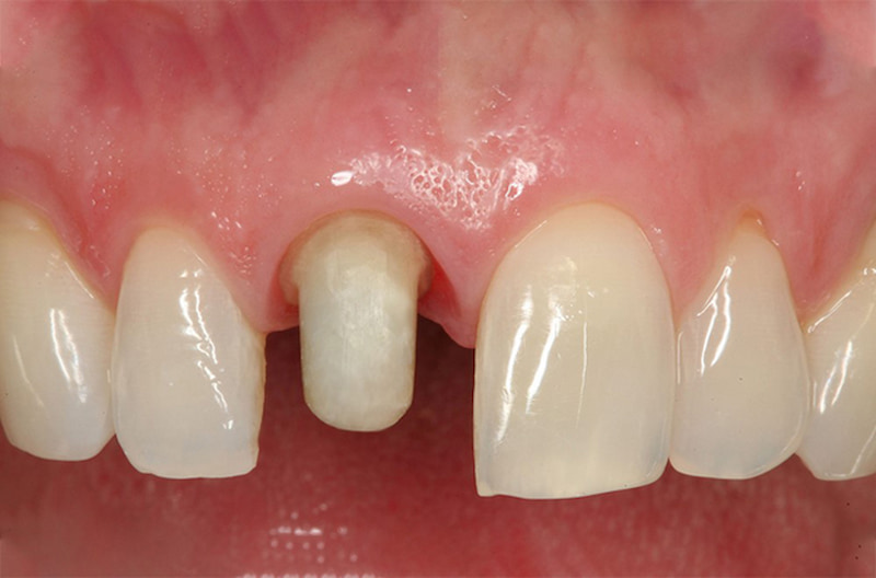 Mài răng bọc sứ gây tác động không nhỏ đến răng thật