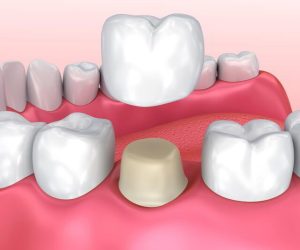 Mão răng sứ là một dạng răng giả có màu sắc, hình dạng giống như răng thật