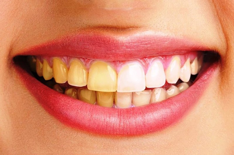 Răng bị nhiễm màu nặng nên thực hiện bọc mão răng sứ