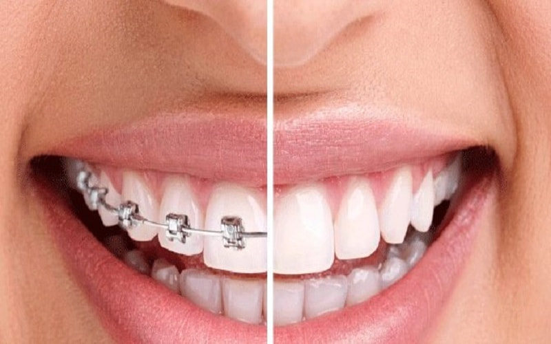 Niềng răng hay bọc sứ thường được quyết định dựa vào tình trạng răng miệng 