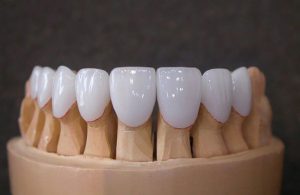 Răng sứ nếu bạn không chăm sóc đúng cách sẽ dễ bị bỉn màu, ố vàng