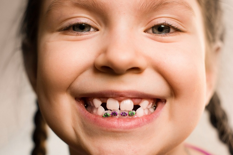Niềng răng ở trẻ nhỏ hiệu quả hơn nhưng cũng rất phức tạp