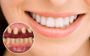 Quy trình bọc răng sứ gồm 5 bước cơ bản