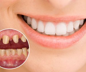 Quy trình bọc răng sứ gồm 5 bước cơ bản