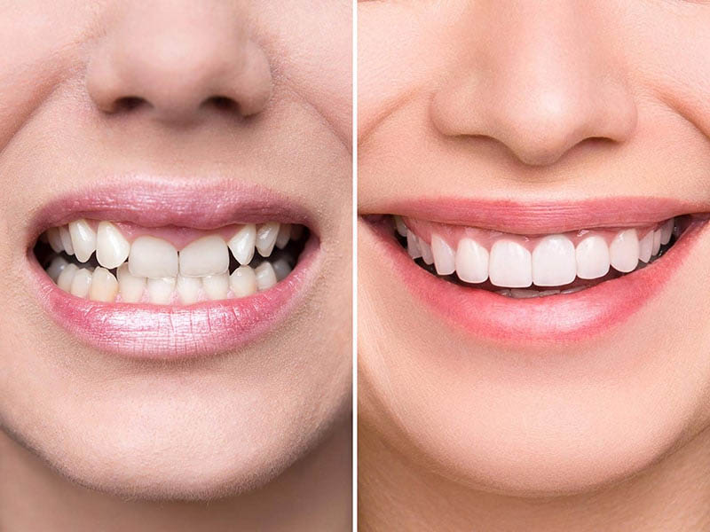 Bọc răng sứ chất lượng giúp bạn sở hữu một nụ cười rạng rỡ