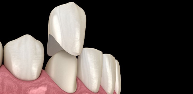 Bọc sứ không đúng cách khiến răng dễ bị tổn thương, chảy máu