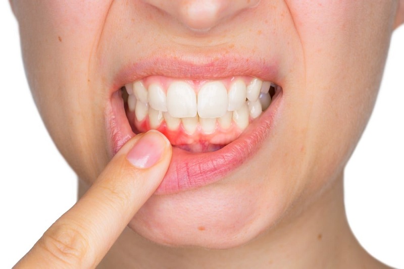 Không chăm sóc tốt răng miệng là nguyên nhân hàng đầu khiến răng bọc sứ bị chảy máu