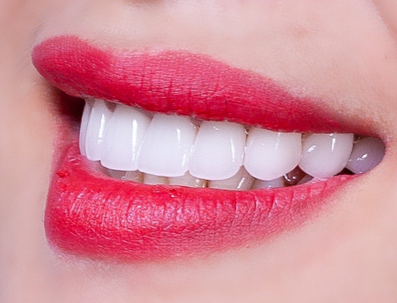 Bọc răng sứ là một phương pháp nha khoa thẩm mỹ phổ biến