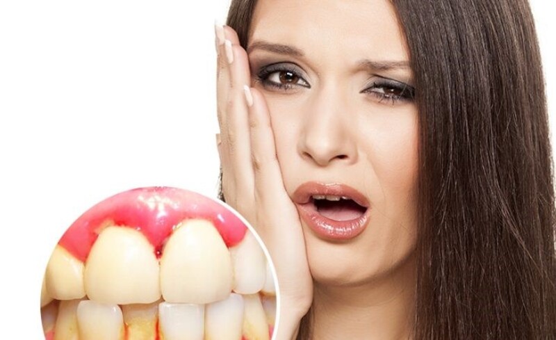 Các loại răng sứ kém chất lượng sẽ gây ra hiện tượng răng bị chảy máu
