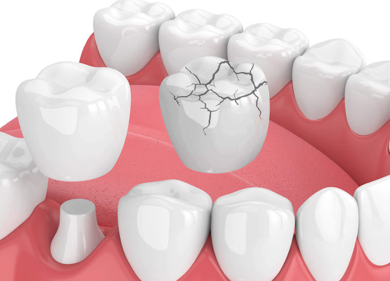 Nếu răng trám bị sứt, mẻ thì có thể bọc sứ để phục hồi