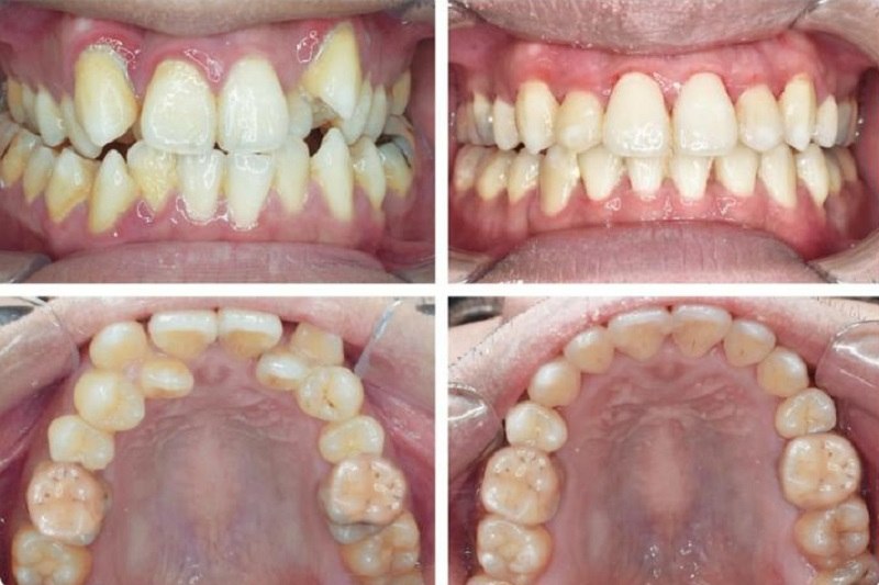 Nhiều người nghĩ đến phương pháp bọc sứ khi răng bị khấp khểnh