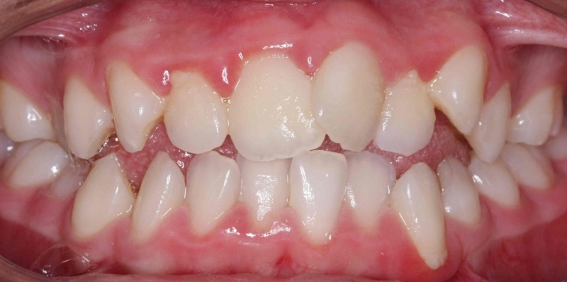 Răng mọc lệch có bọc sứ được không là một trong những vẫn đề được nhiều người quan tâm